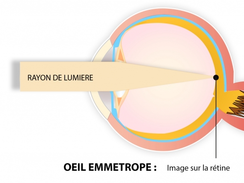 opération laser yeux hypermétropie meilleur paris