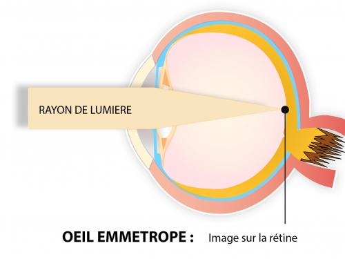 opération laser yeux myopie meilleur paris
