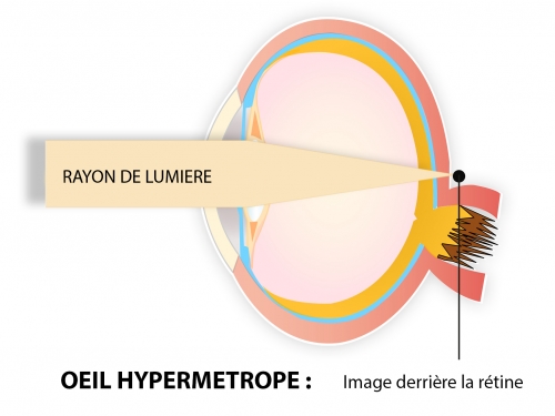 opération laser yeux hypermétropie meilleur paris