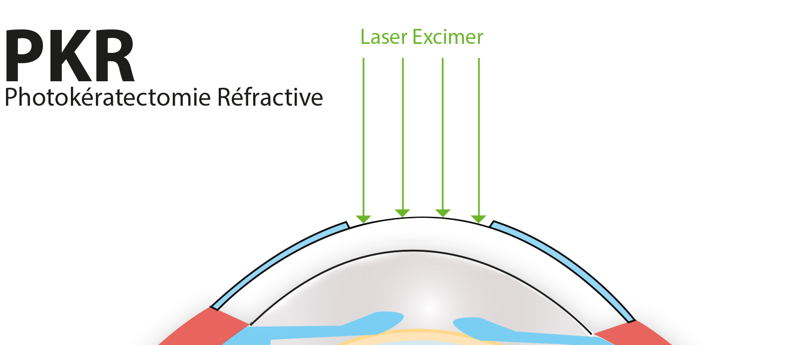 opération PKR myopie laser