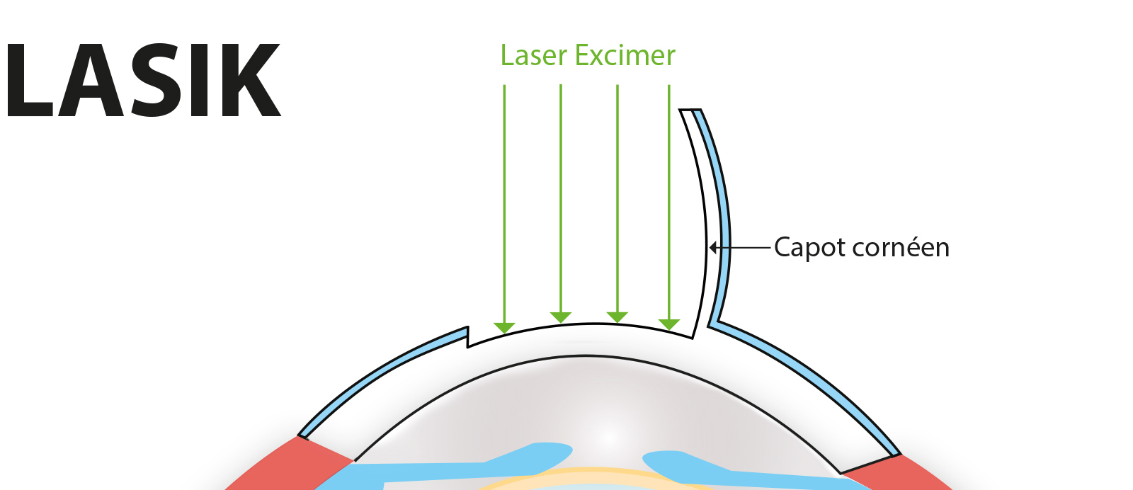 opération LASIK myopie laser