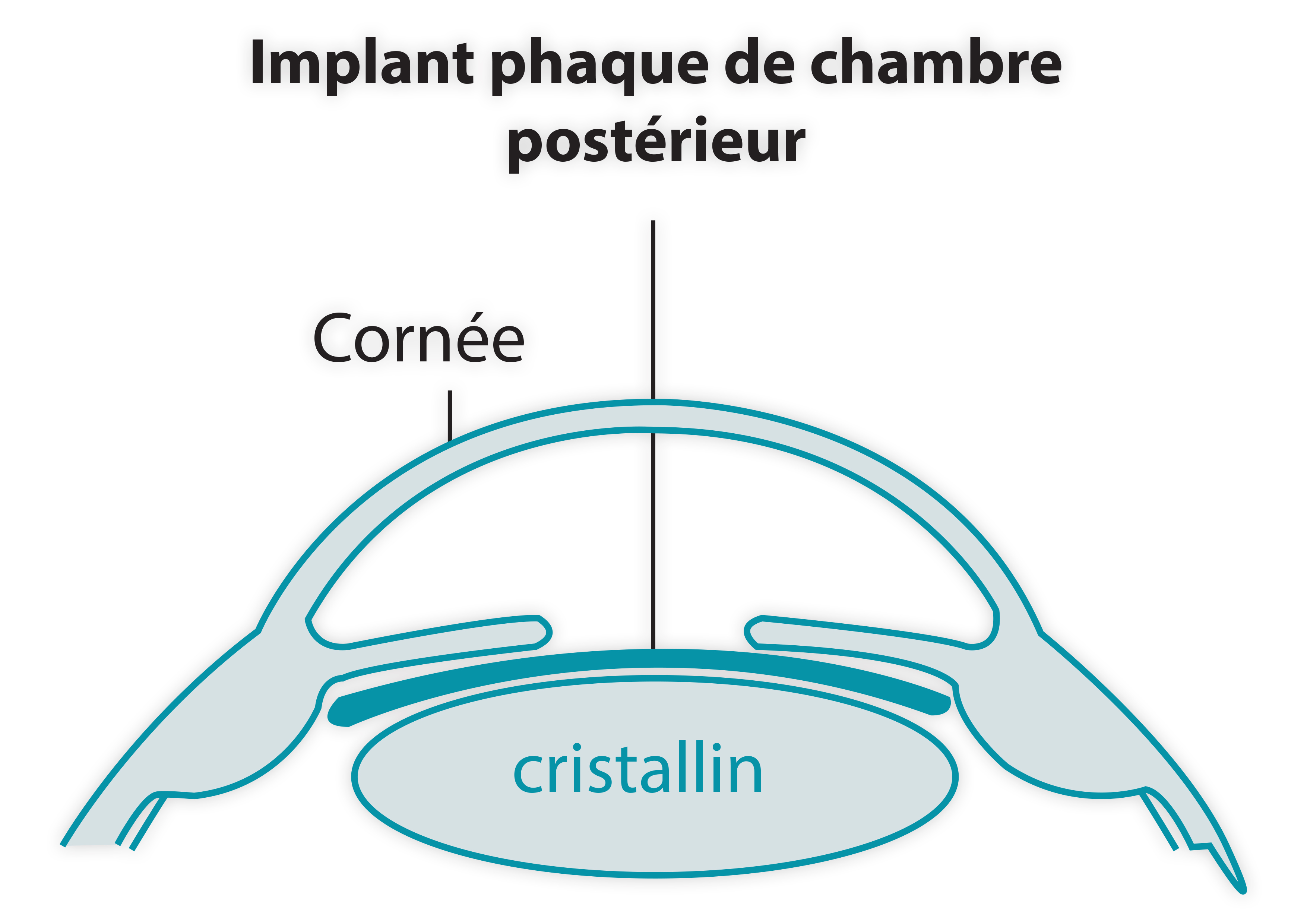implant phaque ICL IPCL myopie