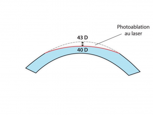 opération laser yeux myopie meilleur paris