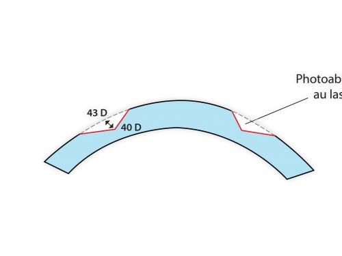 opération laser yeux hypermétropie meilleur paris