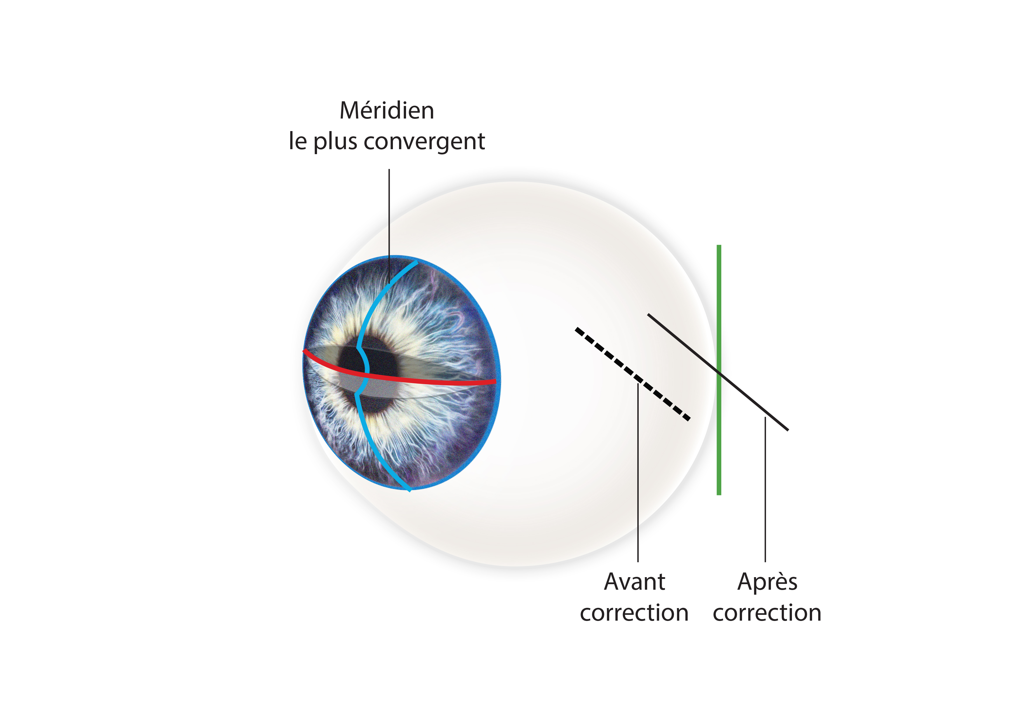 opération astigmatisme laser yeux meilleur paris