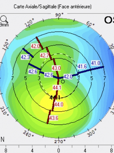 ectasie kératocone fruste asymétrie topographie