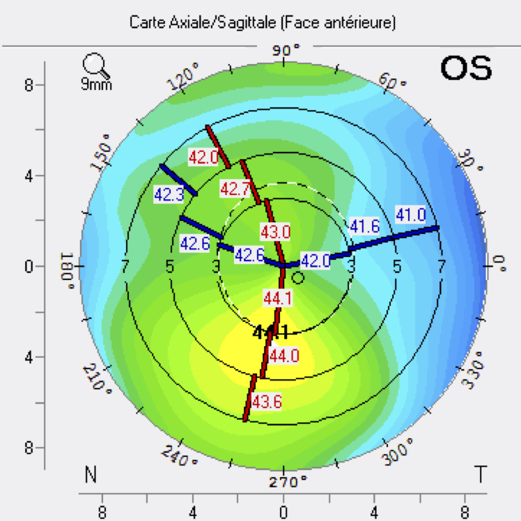 asymétrie inférieure topographie cornéenne kératocone fruste