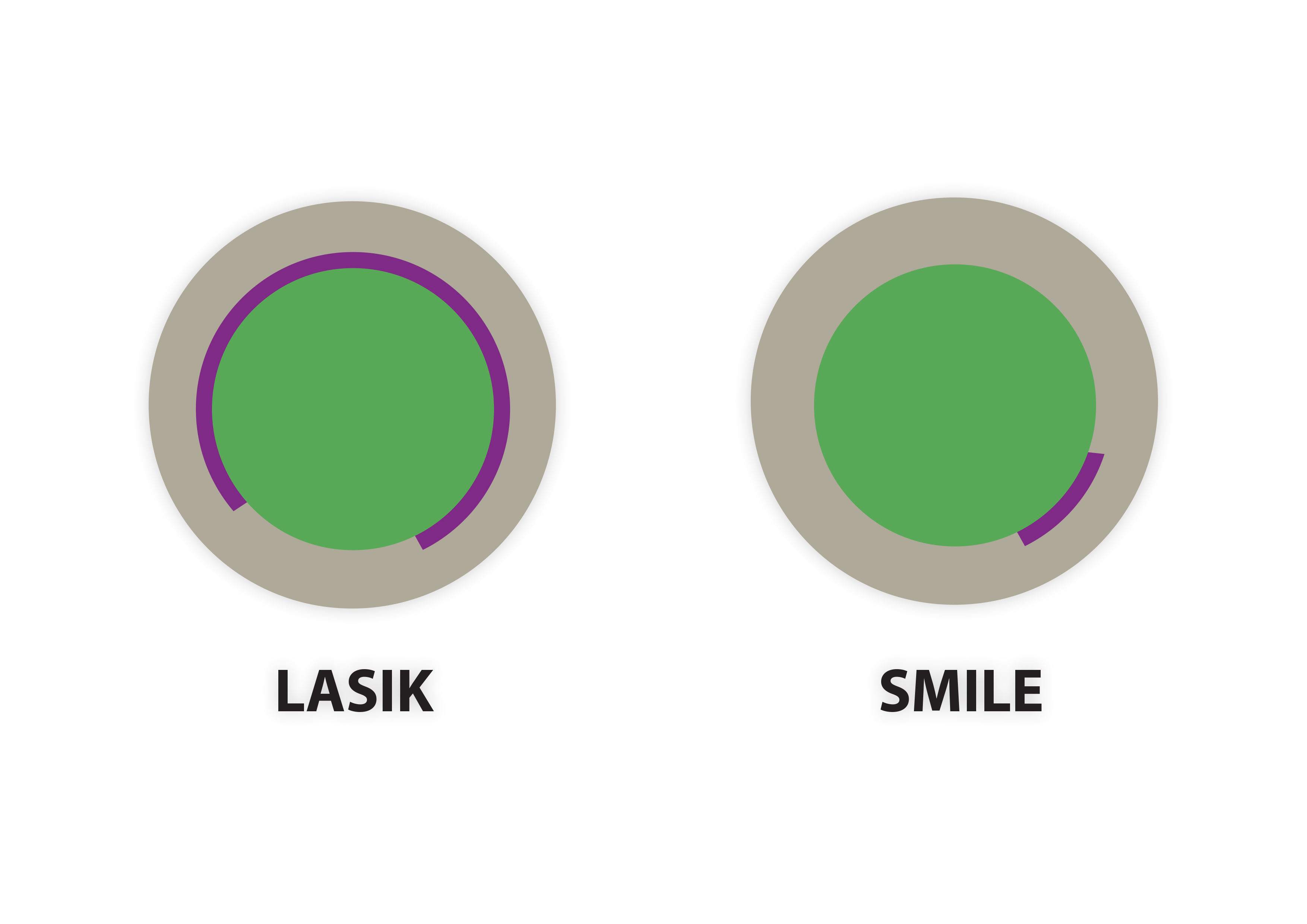 LASIK SMILE opération yeux laser paris