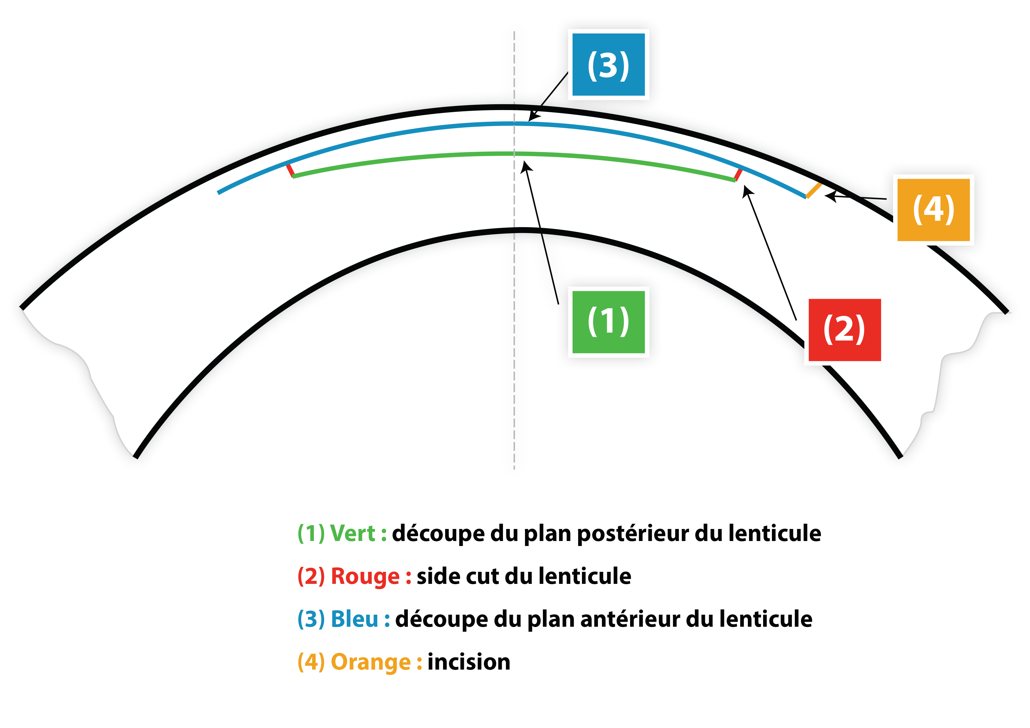 chirurgie SMILE meilleur paris