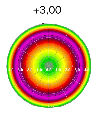 opération lasik laser yeux hypermétropie meilleur paris