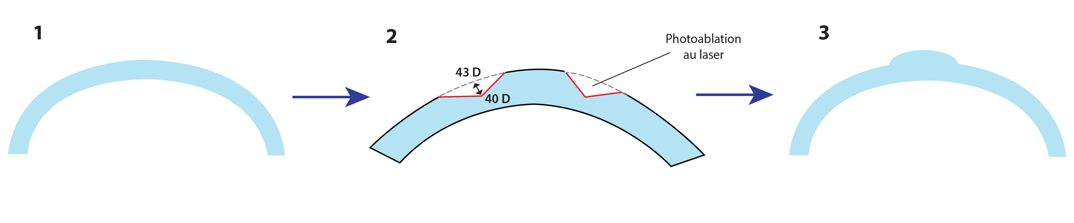 lasik presbytie presbylasik hypermétropie laser