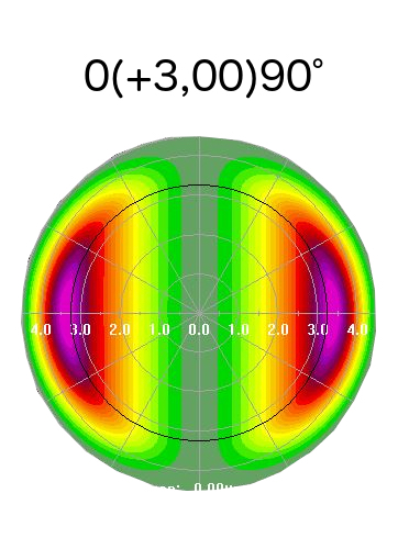 lasik opération astigmatisme laser yeux meilleur paris