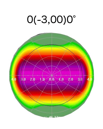 opération astigmatisme laser yeux meilleur paris