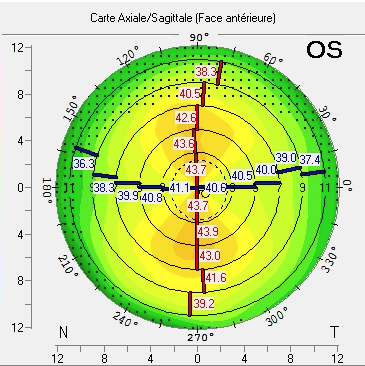 opération astigmatisme laser yeux meilleur paris
