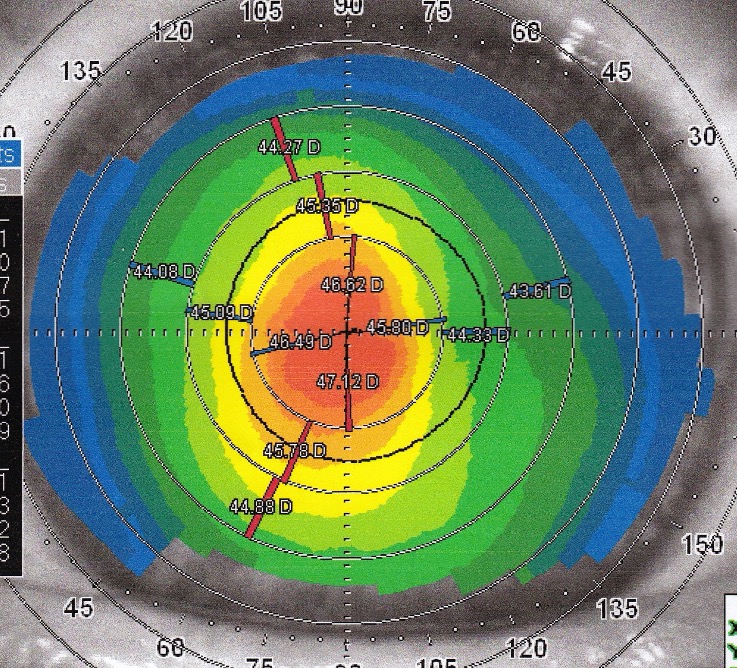 lasik presbytie presbylasik