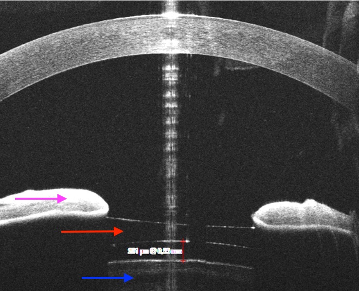 implant phaque ICL IPCL meilleur chirurgien