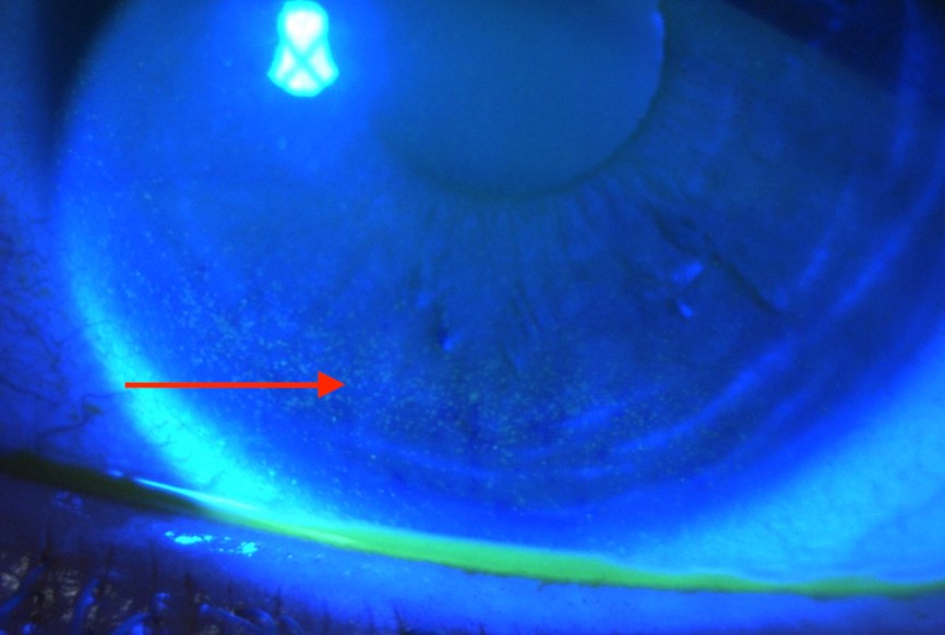 sécheresse oculaire post lasik