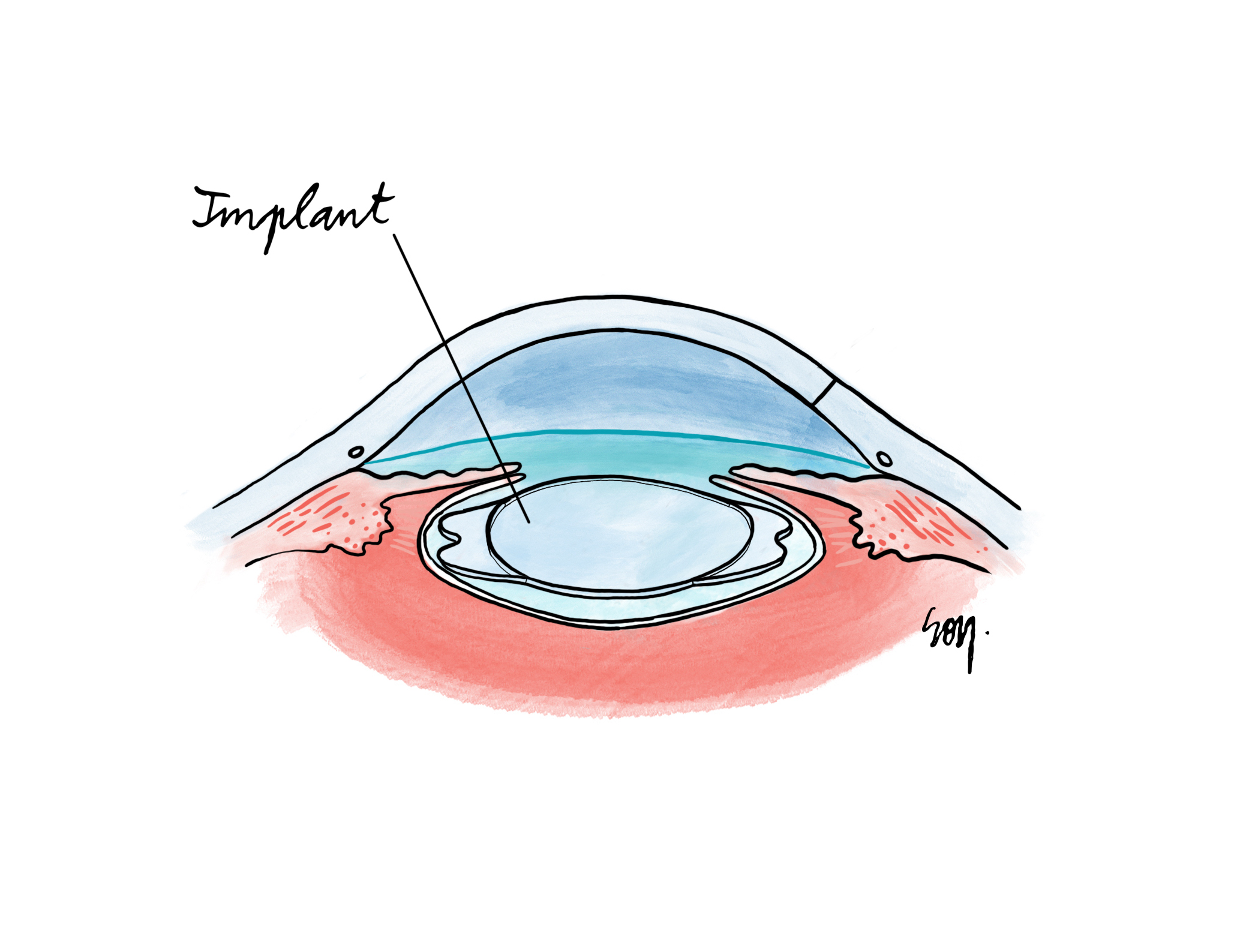 cataracte phacoémulsification chirurgie implant