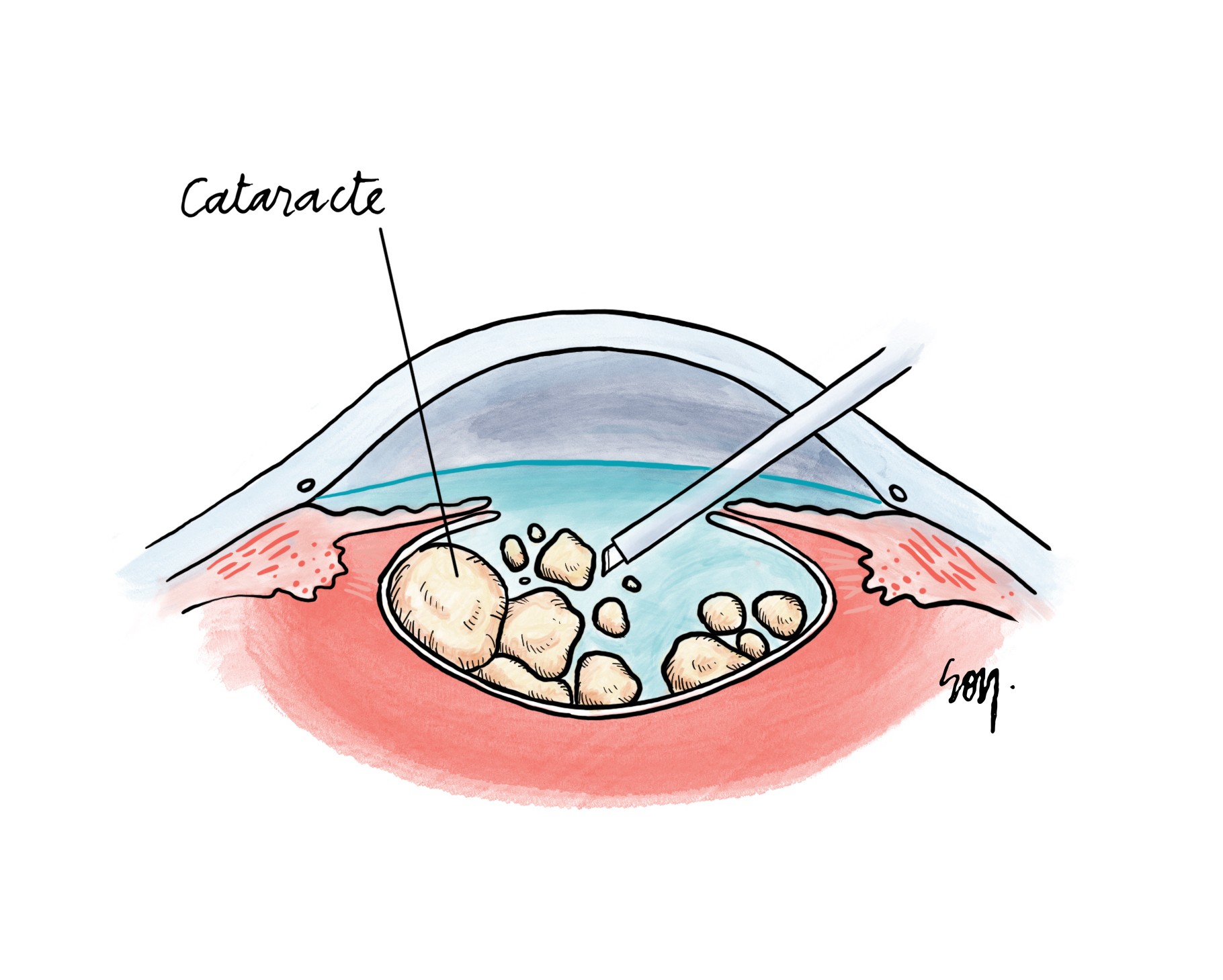 cataracte phacoémulsification chirurgie implant
