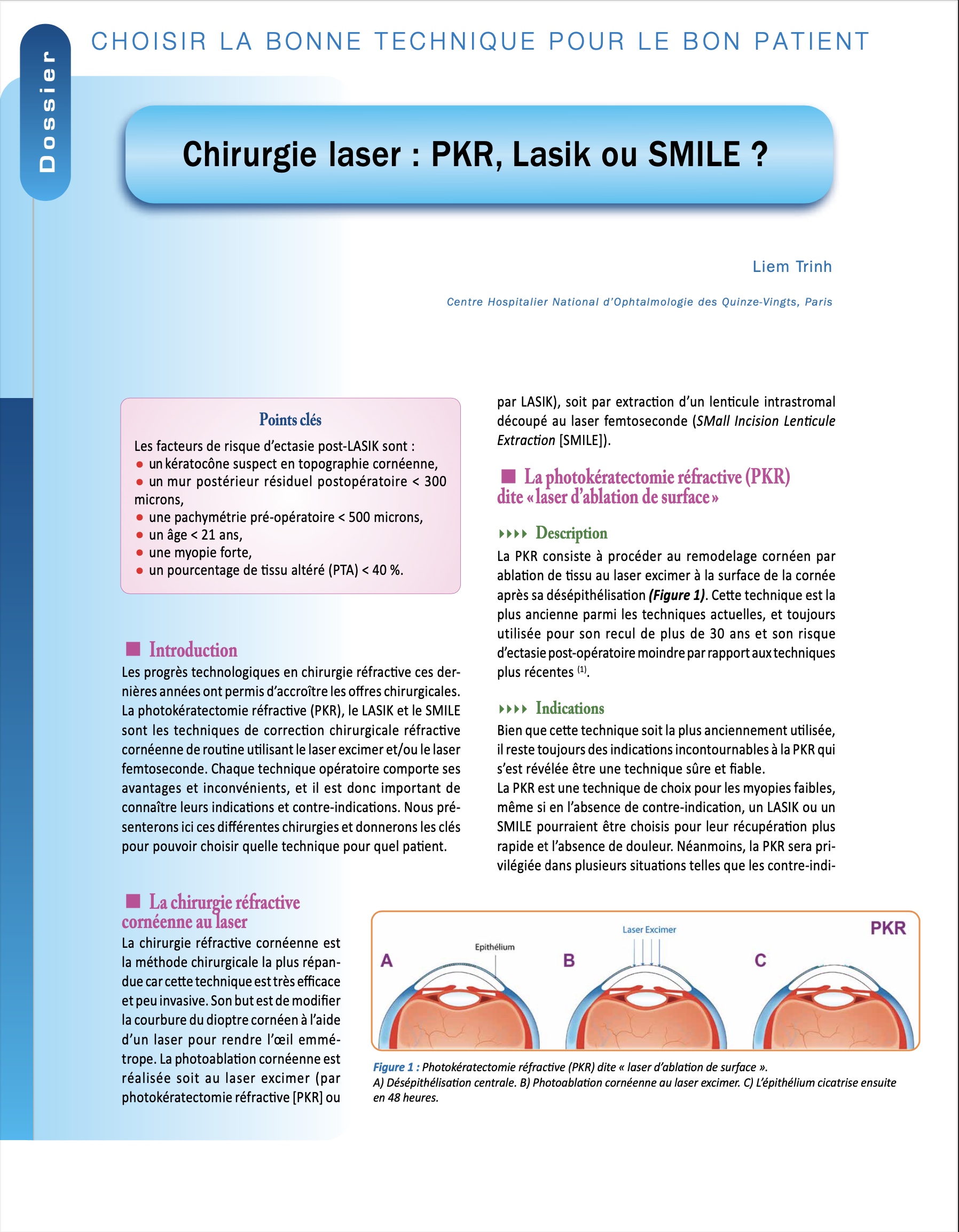 chirurgie laser réfractive pkr lasik smile