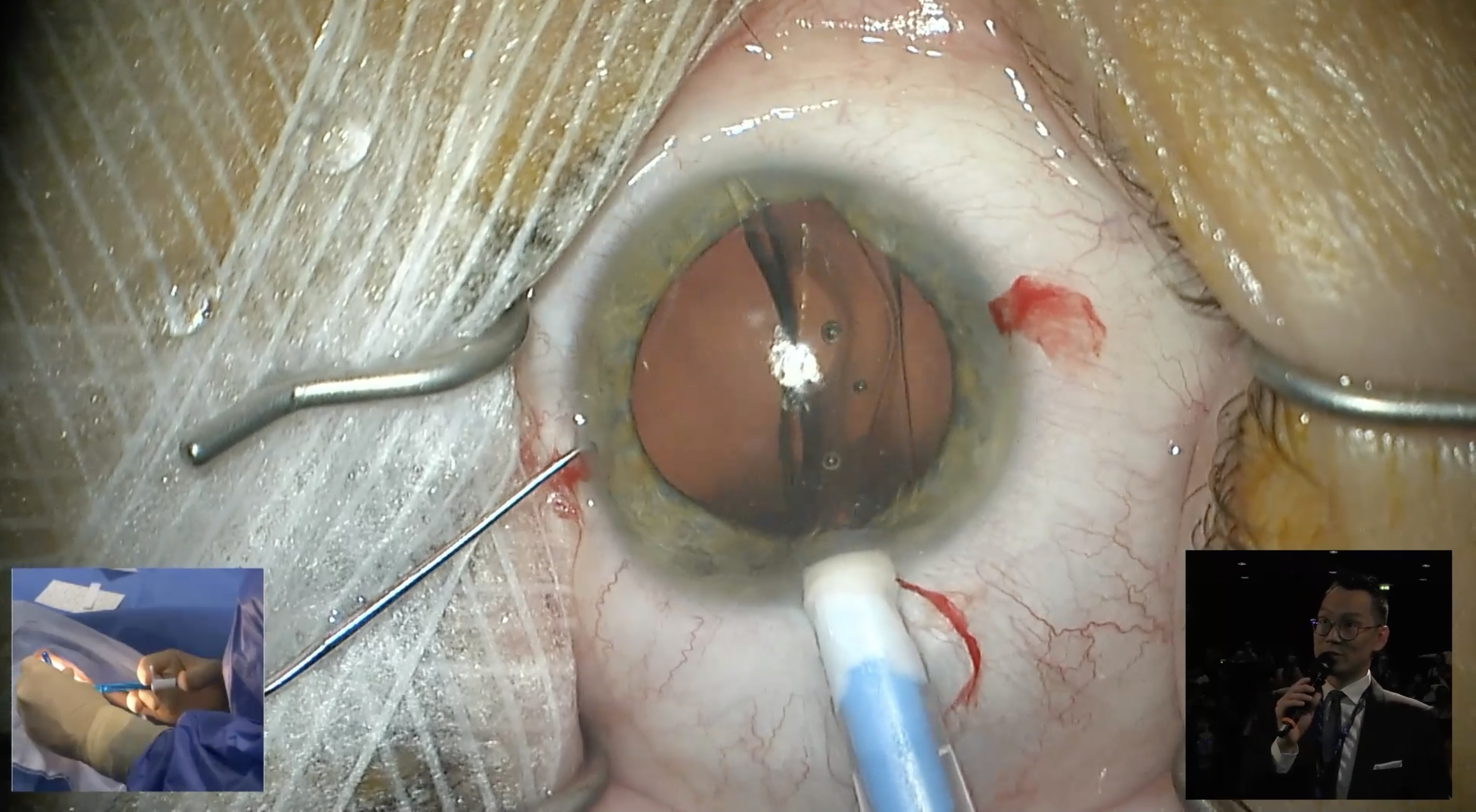 Implant phaque ICL IPCL Paris