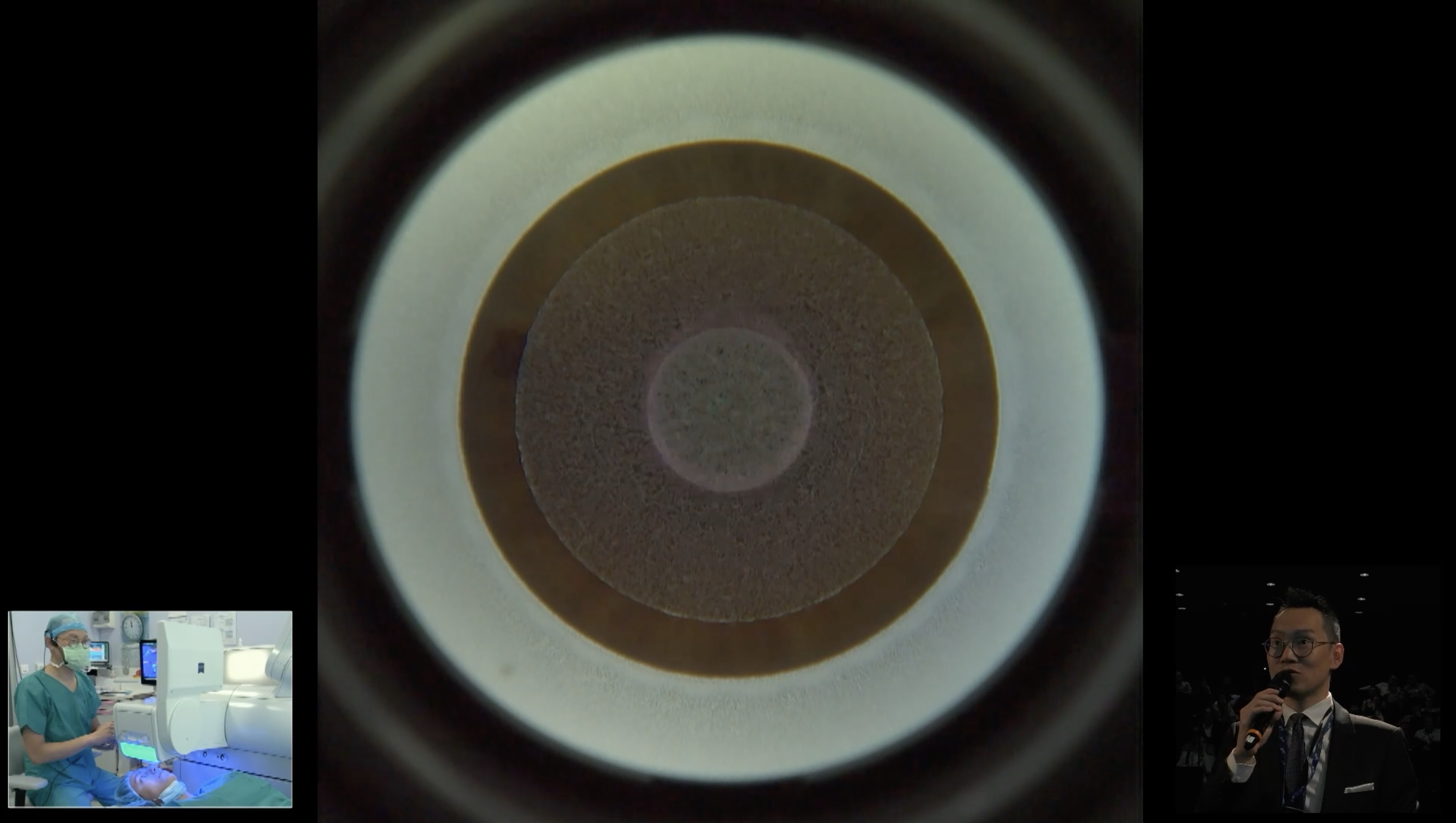 Chirurgie en direct SMILE PRO Visumax 800 Paris