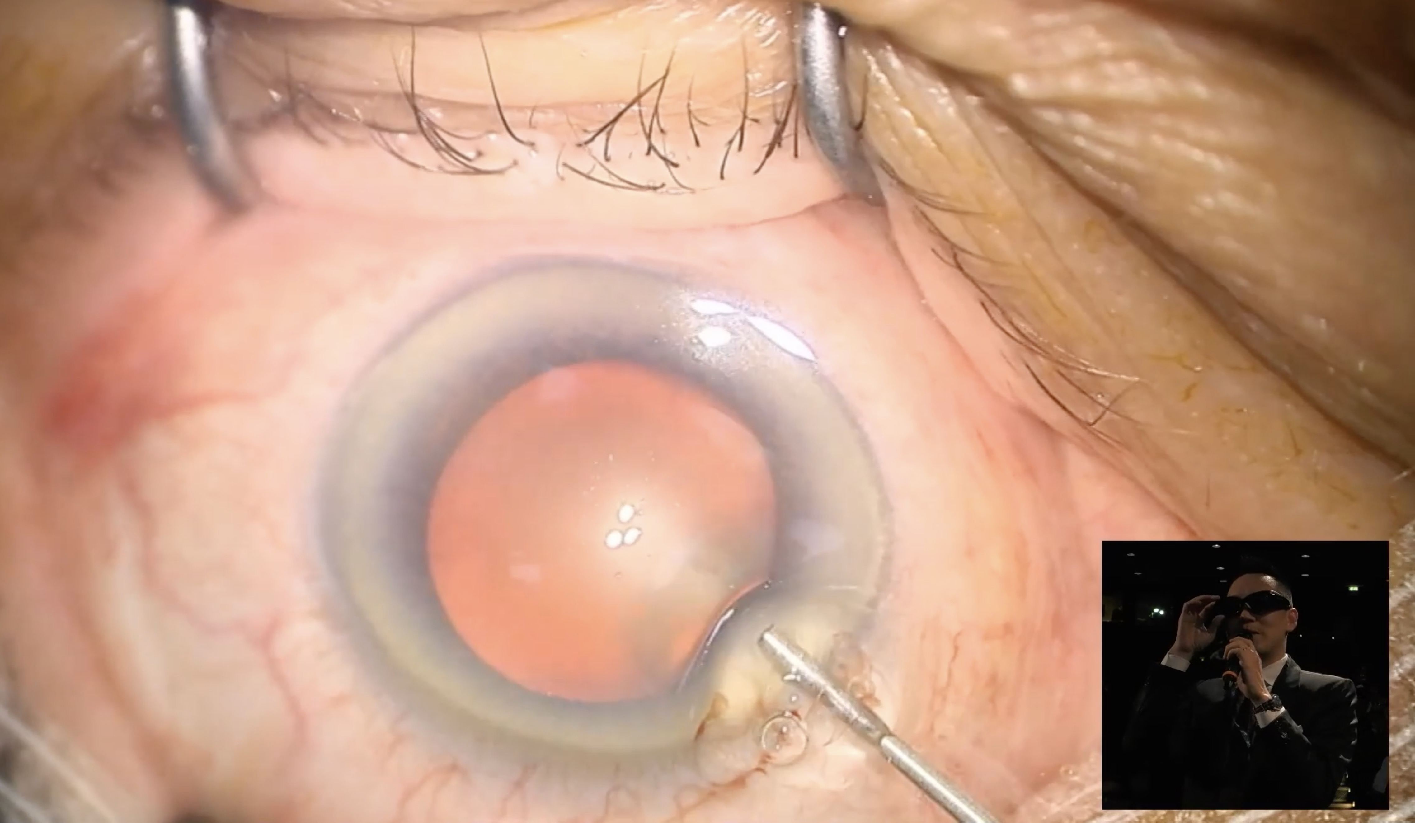 Meilleur Chirurgien cataracte Paris Dr Trinh