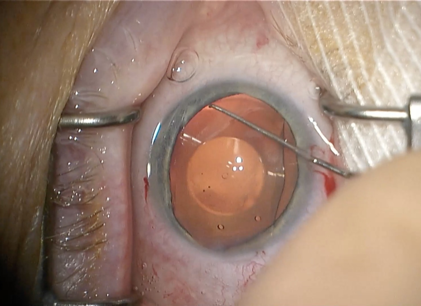 EVO VIVA Phakic IOL Staar